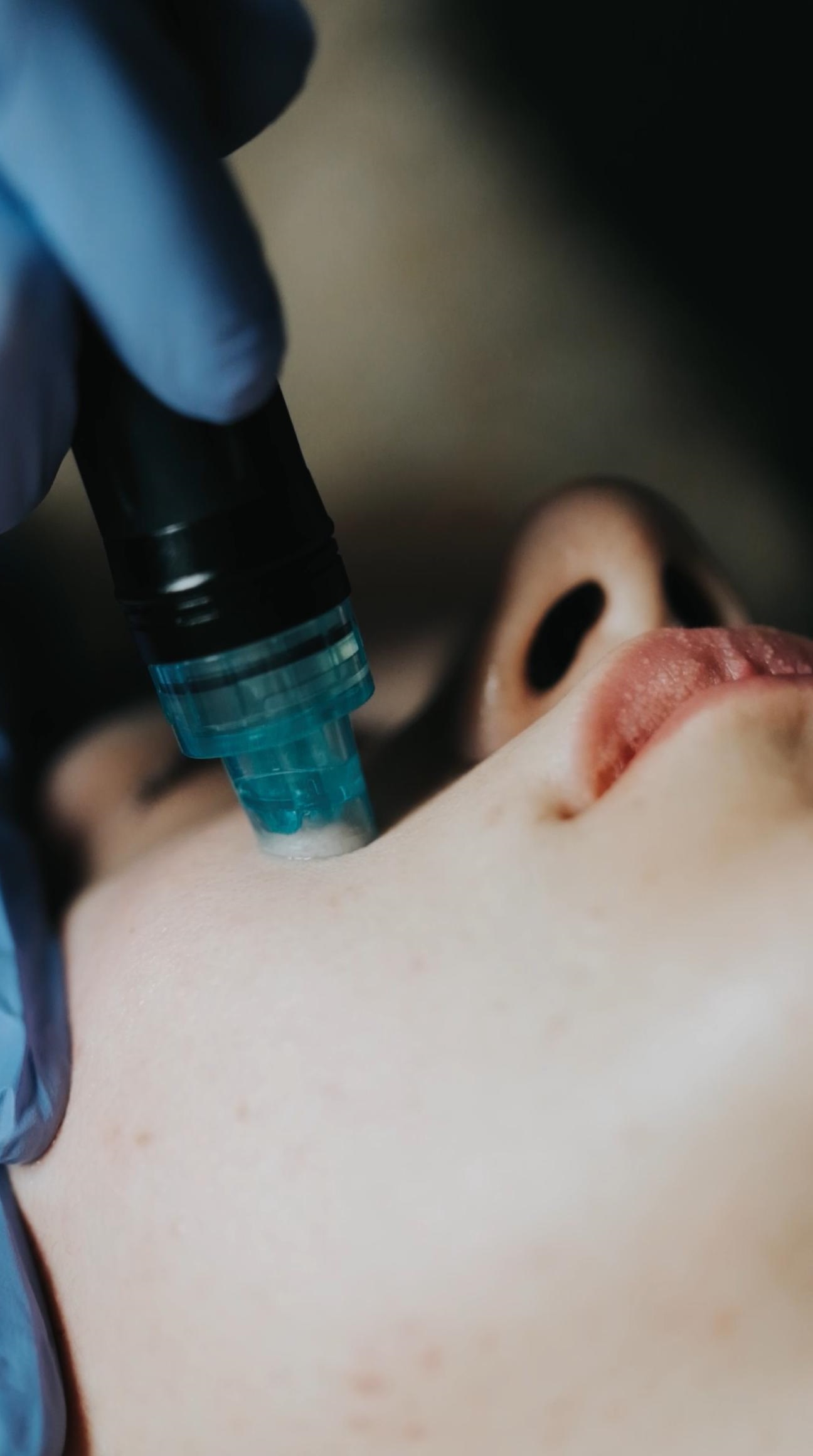 Uşak Merkez’deki Seba Güzellik Merkezi’nde yanak bölgesi için özel olarak uygulanan Hydrafacial hizmeti sunuyoruz Yanak bölgesi için hydrafacial görseli